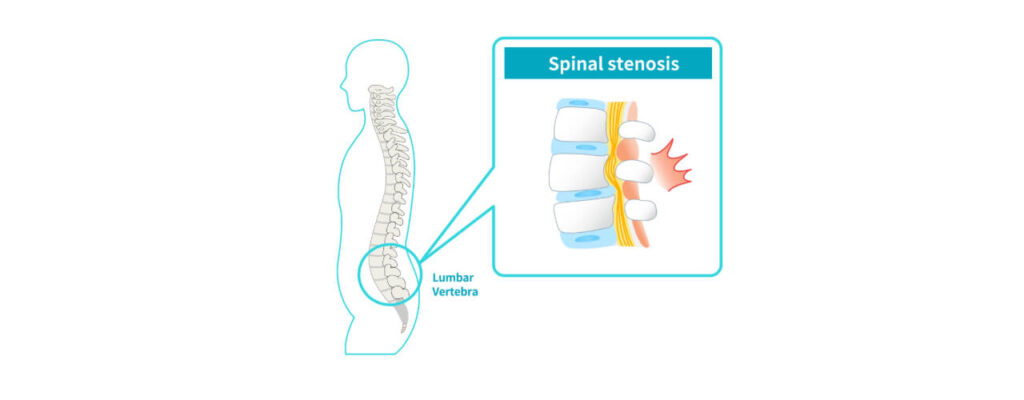 Managing_Spinal_Stenosis_How_Physical_Therapy_Can_Alleviate_Pain_and_Improve_Mobility